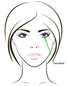 White Sclera Shows on 3 Sides of Iris