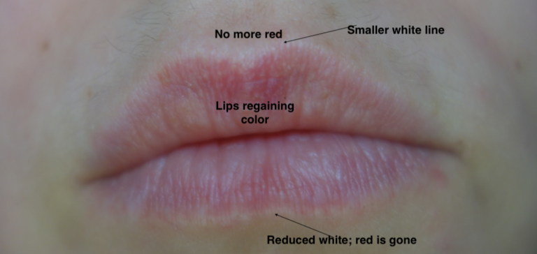 white-line-around-the-lips-rebecca-wood-st-charles