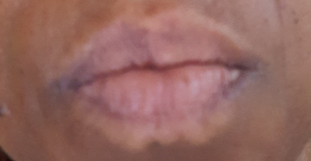 What Causes A White Line Around The Lips Sitelip