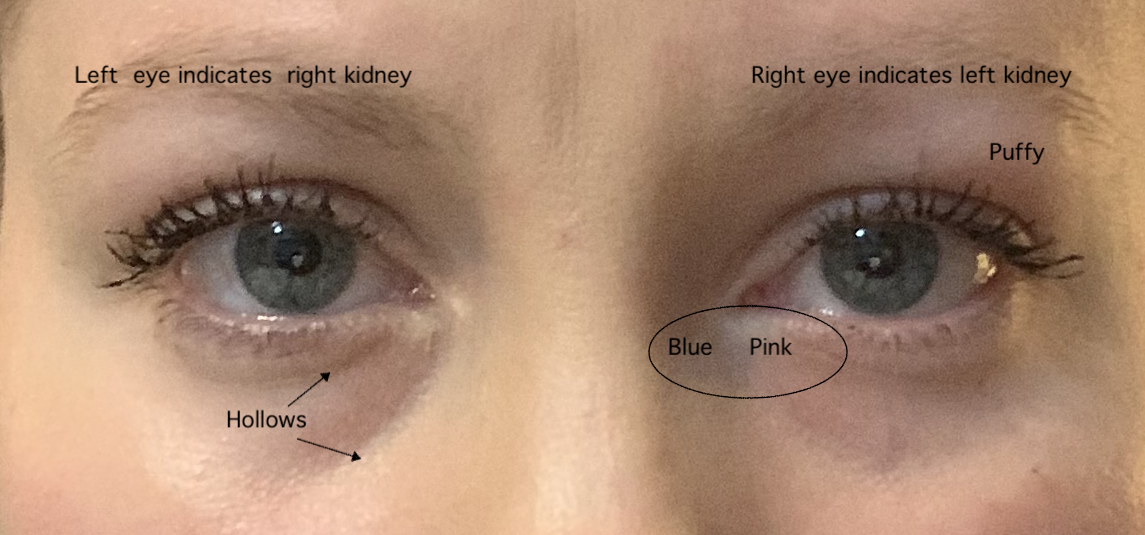 Kidney Stones Water Retention And Face Reading Rebecca Wood